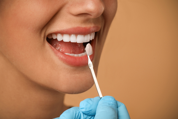 The Importance Of Choosing A Dental Professional For Dental Veneers